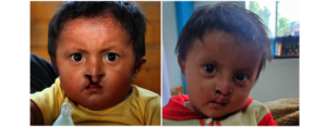 Before and After Surgery