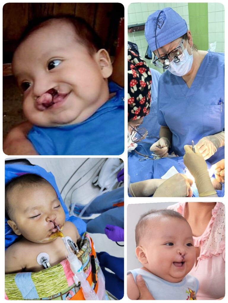 Help 40 children receive cleft surgery in Peru