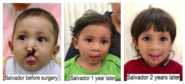 Help 40 children receive cleft surgery in Peru