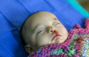 Help 40 children receive cleft surgery in Peru