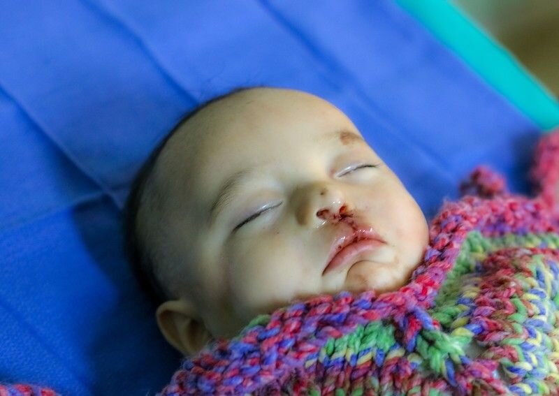 Help 40 children receive cleft surgery in Peru
