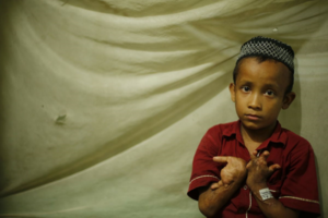 Rifat, Burn Patient (Credit: Jeffrey Davis)