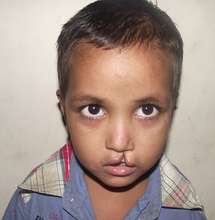 Tareque Before His Incredible Surgery