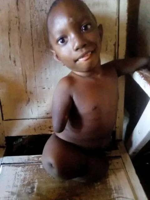 Mobility assistance for disabled children in DRC