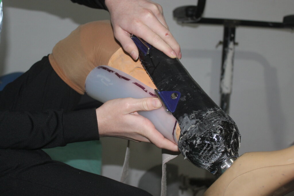 Steps to Recovery: Supporting Syrian Amputees