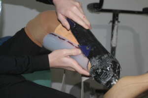 installing the prosthetic limb for child