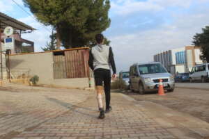 After installing the prosthetic limb