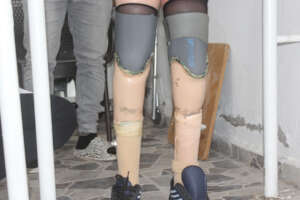 installing the prosthetic limb