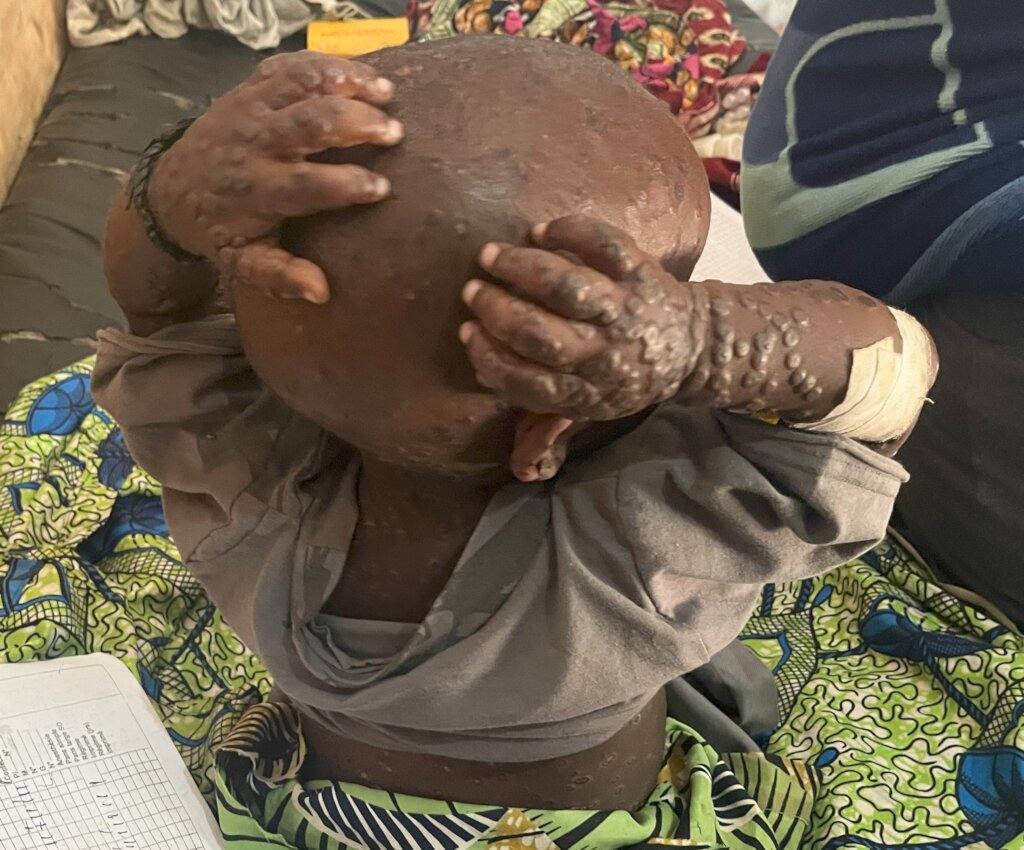 Monkeypox knows no borders. Africa needs your help