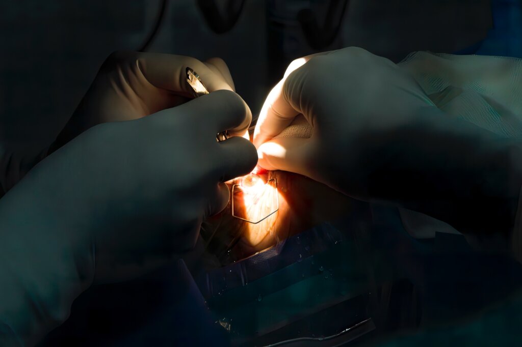 Sponsor Cataract Surgeries for Syrian Refugees