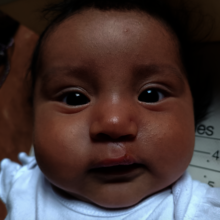Scarlett | After cleft lip surgery