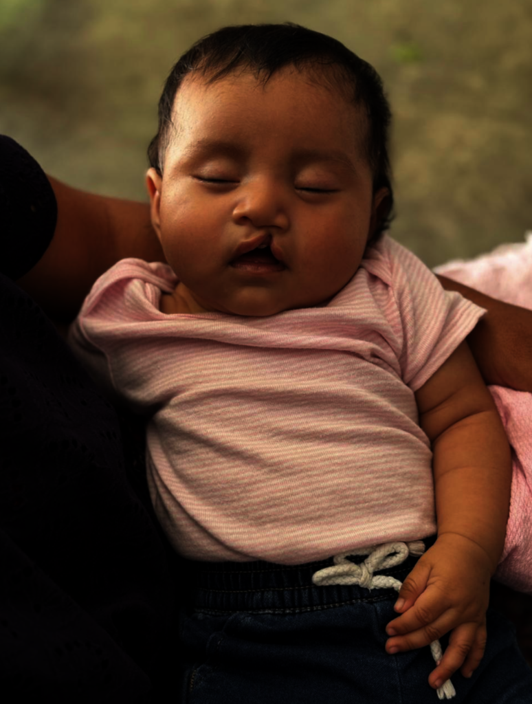 Scarlett | Before cleft lip surgery