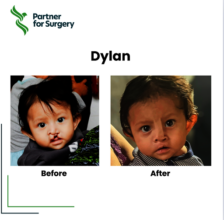 Dylan Before and After his Surgery