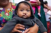 Support Cleft Nutrition in Rural Guatemala
