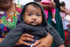 Support Cleft Nutrition in Rural Guatemala