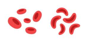 Diagram of Sickled Red Blood Cells