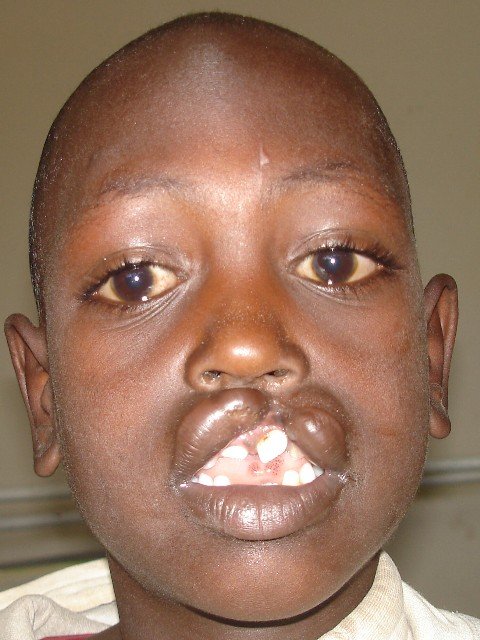 Cleft lip/palate surgery for African children