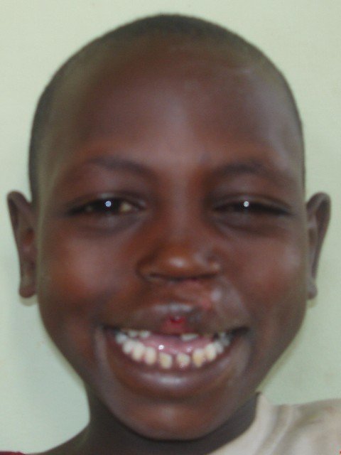 Cleft lip/palate surgery for African children