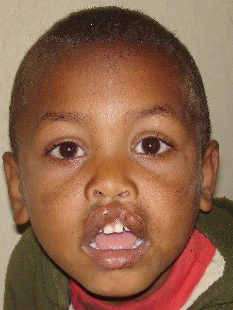 Cleft lip/palate surgery for African children