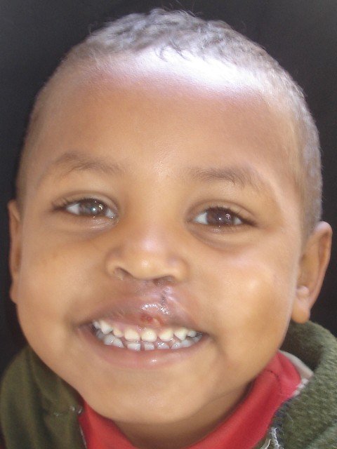 Cleft lip/palate surgery for African children