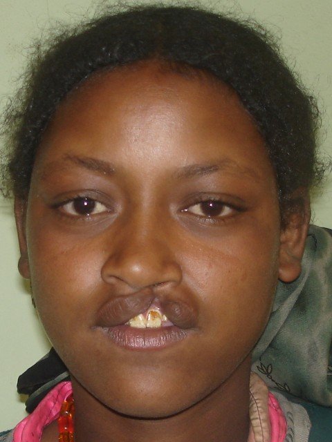 Cleft lip/palate surgery for African children