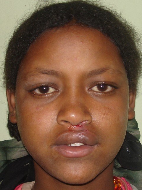 Cleft lip/palate surgery for African children
