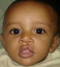Before surgery