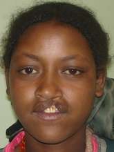 Nejo before surgery