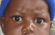 Cleft lip/palate surgery for African children