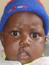 Cleft lip/palate surgery for African children
