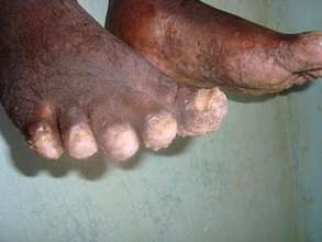 TUNGIASIS/JIGGERS INFESTATION