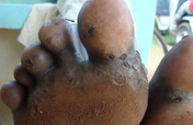 Free Ugenya rural women and children from jiggers