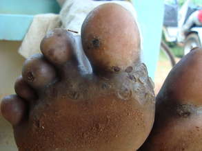 Free Ugenya rural women and children from jiggers