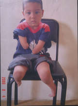 little boy with severe birth defects