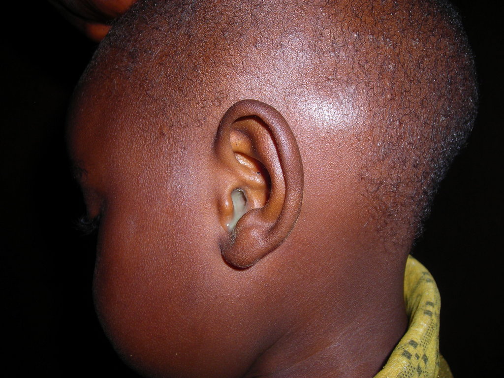 Health & Education - Children who are Deaf DRCongo