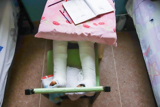 Joel legs in bandages after the corrective surgery