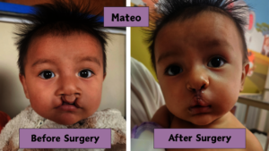Mateo before and after surgery