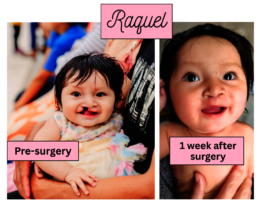 Raquel before and after surgery