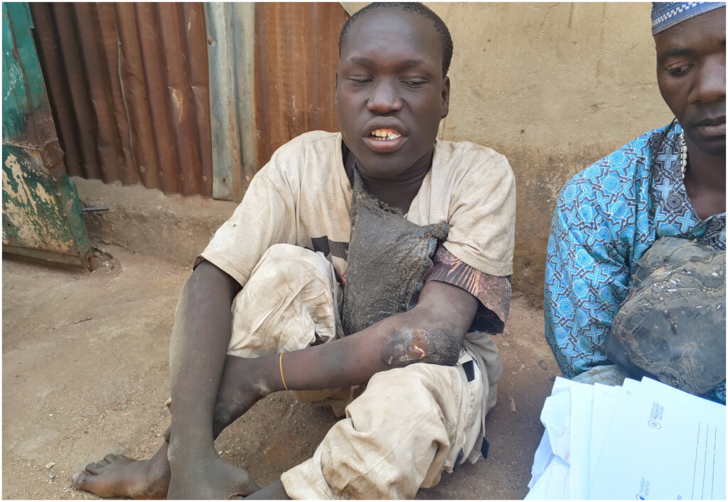 Provide Medical Help for Disabled People with HIV+