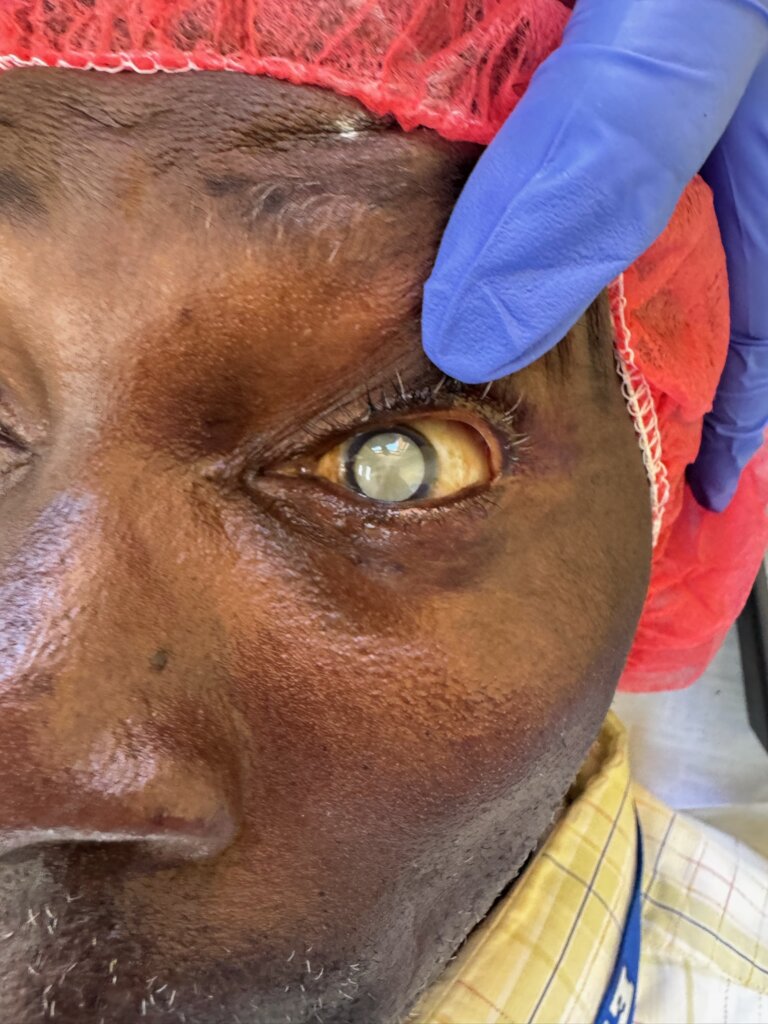 Cataract Surgeries That Build the Future