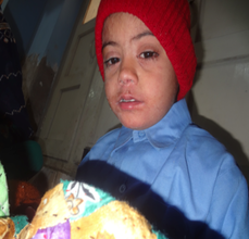 Child admitted  with measles