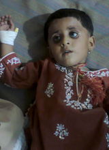 Child admitted with Gastroenteritis - Shikarpur