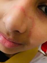 Ramla before treatment