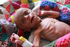 Malnourished Child