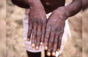 Protect Goma Families from Mpox Outbreak
