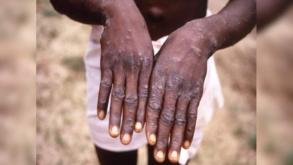 Protect Goma Families from Mpox Outbreak
