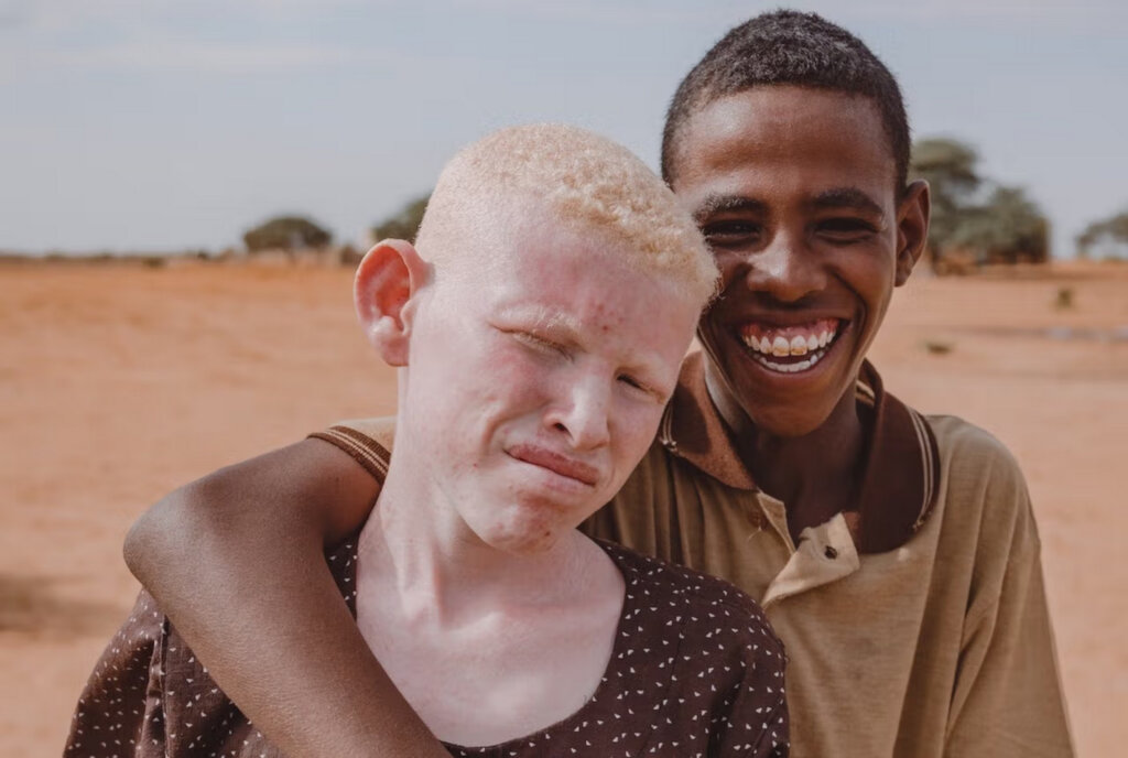 Give 500 Eyeglasses to Rural People with Albinism