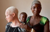 Give 500 Eyeglasses to Rural People with Albinism