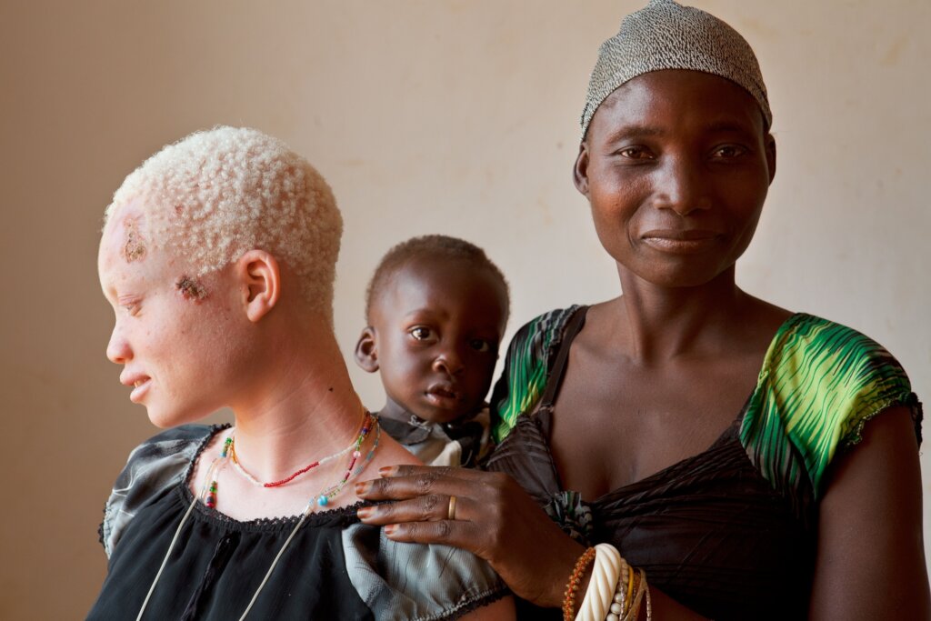 Give 500 Eyeglasses to Rural People with Albinism