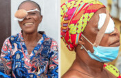 Fund Cataract Surgery for 500 Elderly Nigerians
